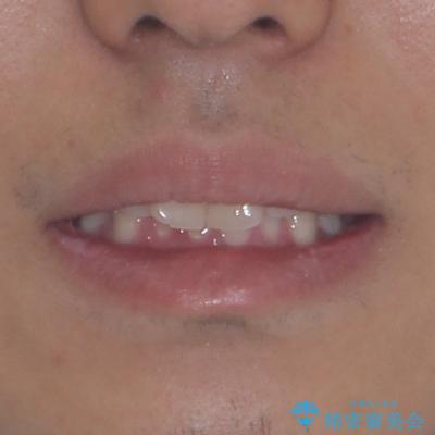 デコボコをインビザライン矯正で改善 奥歯は補助装置で確実に移動をの治療前(顔貌)
