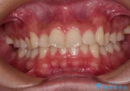 デコボコをインビザライン矯正で改善 奥歯は補助装置で確実に移動をの症例 治療前