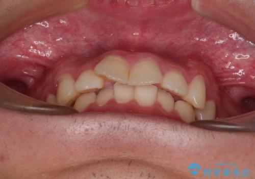 デコボコをインビザライン矯正で改善 奥歯は補助装置で確実に移動をの治療前