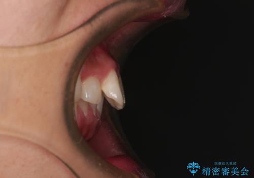 デコボコをインビザライン矯正で改善 奥歯は補助装置で確実に移動をの治療前