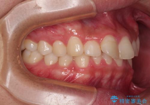 デコボコをインビザライン矯正で改善 奥歯は補助装置で確実に移動をの治療前