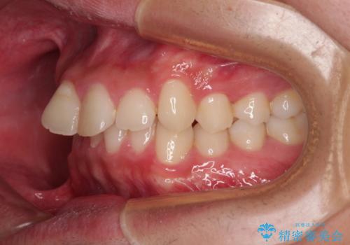 デコボコをインビザライン矯正で改善 奥歯は補助装置で確実に移動をの治療前