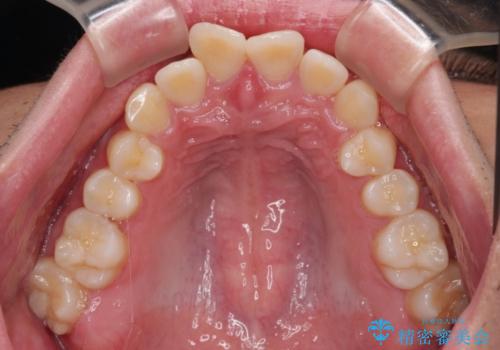 デコボコをインビザライン矯正で改善 奥歯は補助装置で確実に移動をの治療前