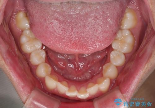 デコボコをインビザライン矯正で改善 奥歯は補助装置で確実に移動をの治療前