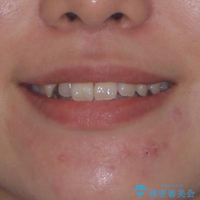 マウスピース矯正が煩わしい ワイヤー装置での非抜歯矯正の治療前(顔貌)