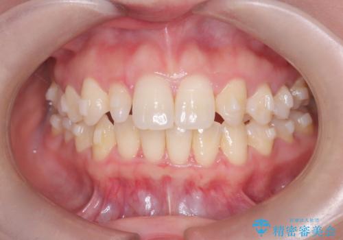 軽度の歯のデコボコ(叢生)をインビザライン(マウスピース)で改善|わずか5か月で整った歯並びにの治療中