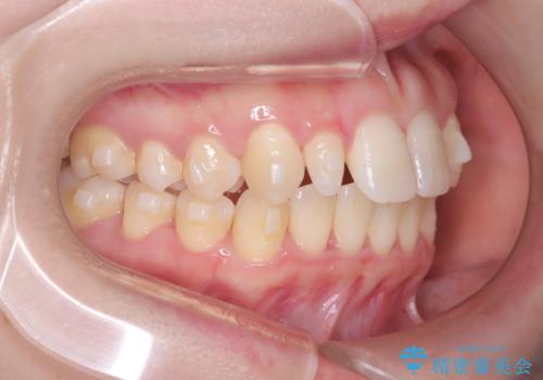 軽度の歯のデコボコ(叢生)をインビザライン(マウスピース)で改善|わずか5か月で整った歯並びにの治療中