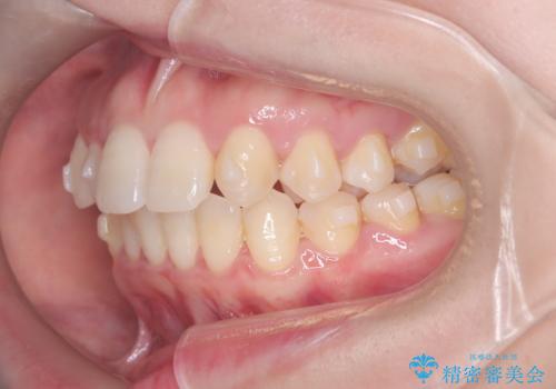 軽度の歯のデコボコ(叢生)をインビザライン(マウスピース)で改善|わずか5か月で整った歯並びにの治療中