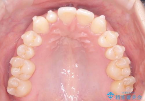 軽度の歯のデコボコ(叢生)をインビザライン(マウスピース)で改善|わずか5か月で整った歯並びにの治療中