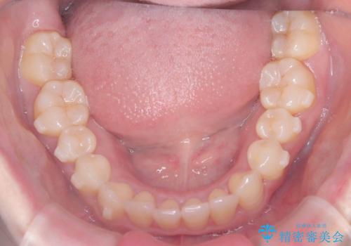 軽度の歯のデコボコ(叢生)をインビザライン(マウスピース)で改善|わずか5か月で整った歯並びにの治療中