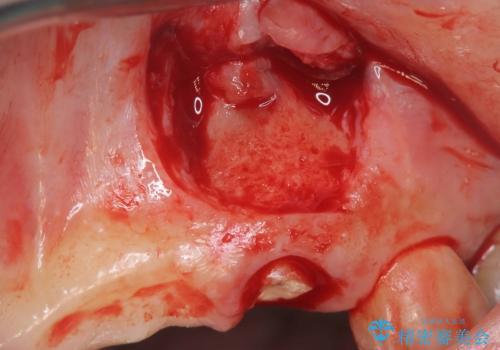 歯茎の腫れが気になる方必見!|抜歯即時インプラントで前歯5本を痛みなく3か月で治療完了!の治療中