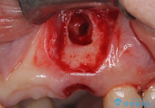歯茎の腫れが気になる方必見!|抜歯即時インプラントで前歯5本を痛みなく3か月で治療完了!の治療中