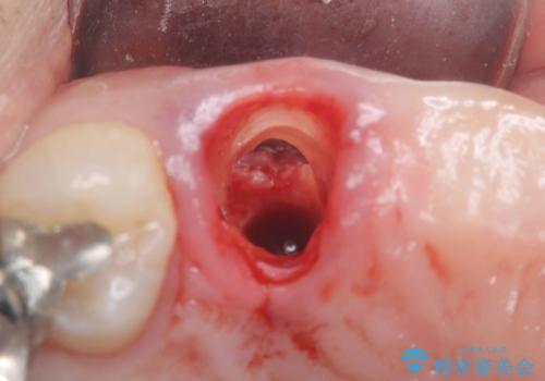 歯茎の腫れが気になる方必見!|抜歯即時インプラントで前歯5本を痛みなく3か月で治療完了!の治療前