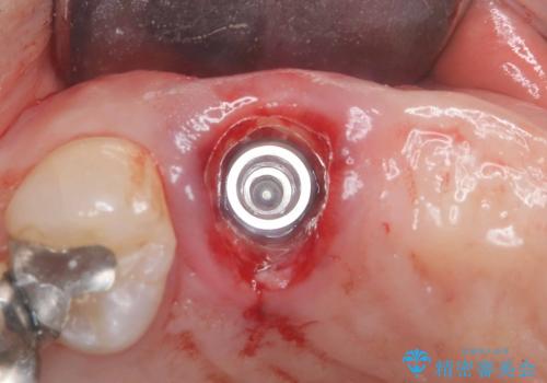 歯茎の腫れが気になる方必見!|抜歯即時インプラントで前歯5本を痛みなく3か月で治療完了!の治療中