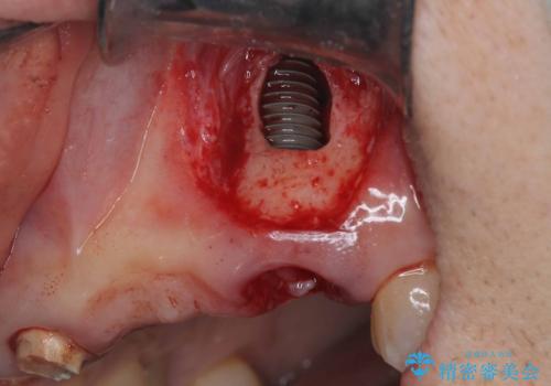 歯茎の腫れが気になる方必見!|抜歯即時インプラントで前歯5本を痛みなく3か月で治療完了!の治療中