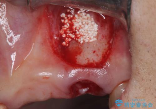 歯茎の腫れが気になる方必見!|抜歯即時インプラントで前歯5本を痛みなく3か月で治療完了!の治療中