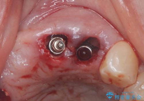 歯茎の腫れが気になる方必見!|抜歯即時インプラントで前歯5本を痛みなく3か月で治療完了!の治療中