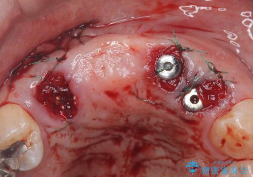 歯茎の腫れが気になる方必見!|抜歯即時インプラントで前歯5本を痛みなく3か月で治療完了!の治療前