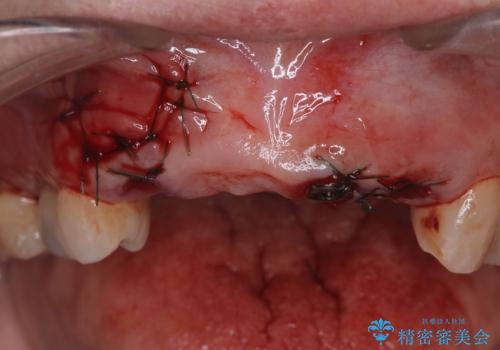 歯茎の腫れが気になる方必見!|抜歯即時インプラントで前歯5本を痛みなく3か月で治療完了!の治療前