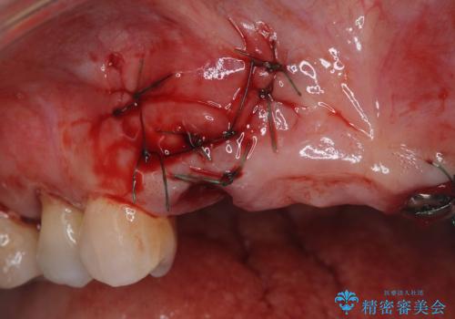 歯茎の腫れが気になる方必見!|抜歯即時インプラントで前歯5本を痛みなく3か月で治療完了!の治療中