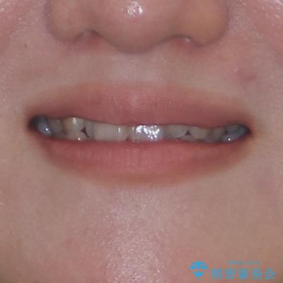 急速拡大装置 狭い歯列を拡大してクロスバイトを短期間矯正治療の治療前(顔貌)