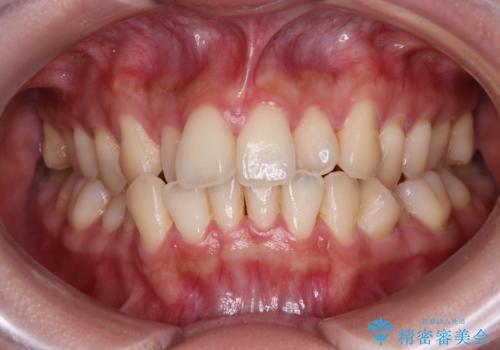 急速拡大装置 狭い歯列を拡大してクロスバイトを短期間矯正治療の症例 治療前