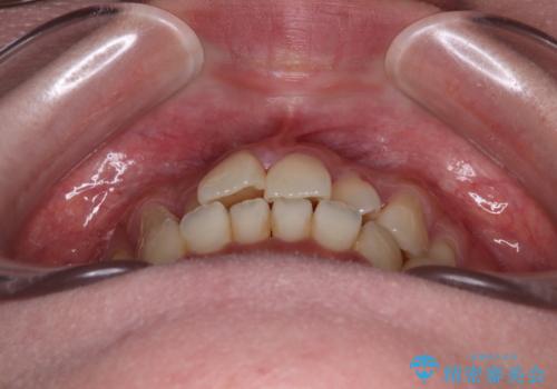 急速拡大装置 狭い歯列を拡大してクロスバイトを短期間矯正治療の治療前