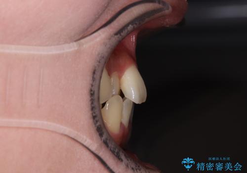 急速拡大装置 狭い歯列を拡大してクロスバイトを短期間矯正治療の治療前