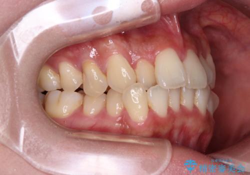 急速拡大装置 狭い歯列を拡大してクロスバイトを短期間矯正治療の治療前