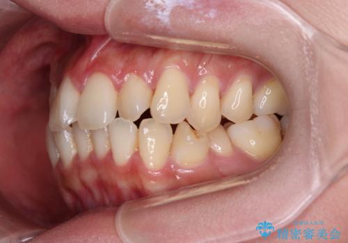 急速拡大装置 狭い歯列を拡大してクロスバイトを短期間矯正治療の治療前