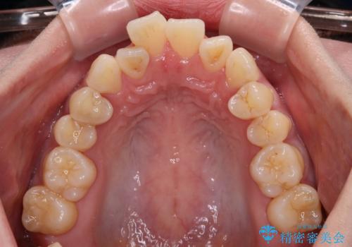 急速拡大装置 狭い歯列を拡大してクロスバイトを短期間矯正治療の治療前