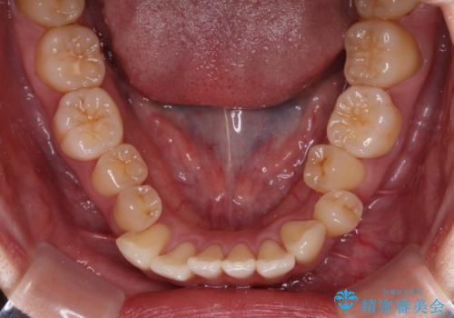 急速拡大装置 狭い歯列を拡大してクロスバイトを短期間矯正治療の治療前