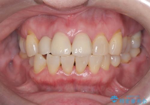 前歯の隙間とへこみが舌で触ると気になる|矯正治療は絶対にしたくない|抜歯即時インプラント+オールセラミッククラウンで審美修復の治療後