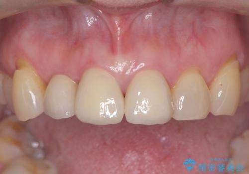 前歯の隙間とへこみが舌で触ると気になる|矯正治療は絶対にしたくない|抜歯即時インプラント+オールセラミッククラウンで審美修復の症例 治療後
