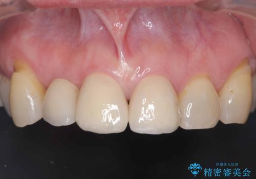 前歯の隙間とへこみが舌で触ると気になる|矯正治療は絶対にしたくない|抜歯即時インプラント+オールセラミッククラウンで審美修復の治療後