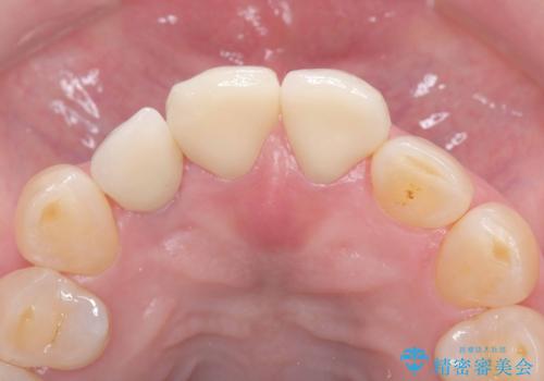 前歯の隙間とへこみが舌で触ると気になる|矯正治療は絶対にしたくない|抜歯即時インプラント+オールセラミッククラウンで審美修復の治療後