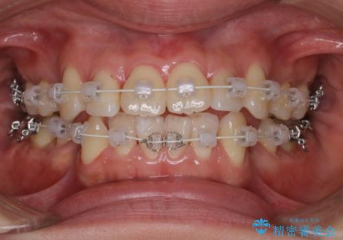 【審美装置】前歯のデコボコを綺麗にの治療中