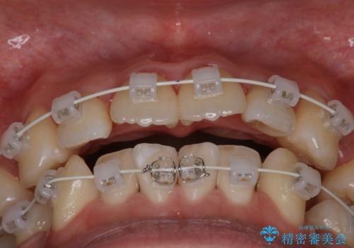 【審美装置】前歯のデコボコを綺麗にの治療中