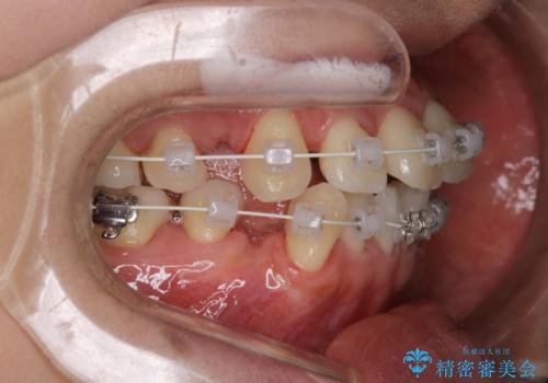 【審美装置】前歯のデコボコを綺麗にの治療中