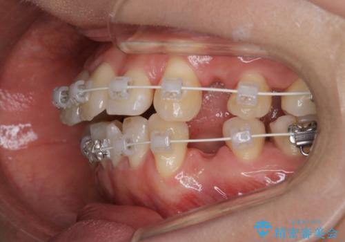 【審美装置】前歯のデコボコを綺麗にの治療中