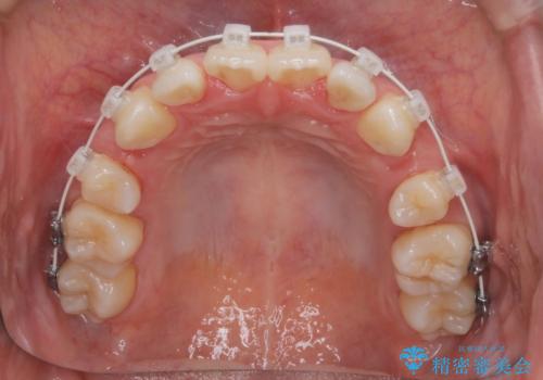【審美装置】前歯のデコボコを綺麗にの治療中
