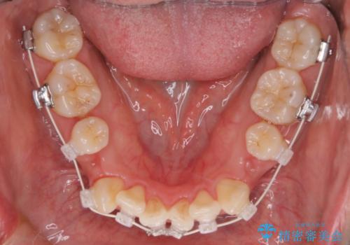 【審美装置】前歯のデコボコを綺麗にの治療中