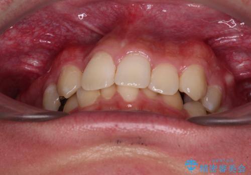 前歯のデコボコと正中のずれを改善!白い装置で目立たない矯正の治療前