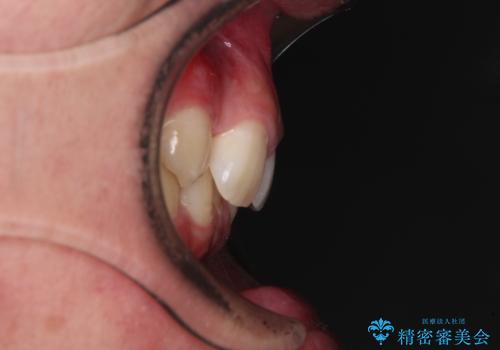 前歯のデコボコと正中のずれを改善!白い装置で目立たない矯正の治療前