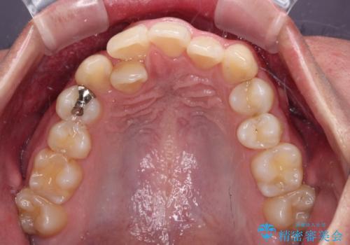 前歯のデコボコと正中のずれを改善!白い装置で目立たない矯正の治療前