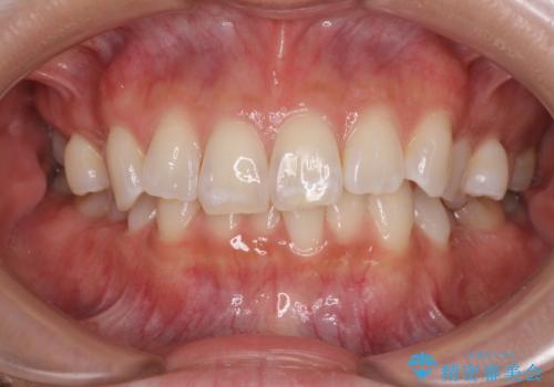 デコボコの非抜歯矯正 ワイヤー装置で楽して改善の症例 治療前