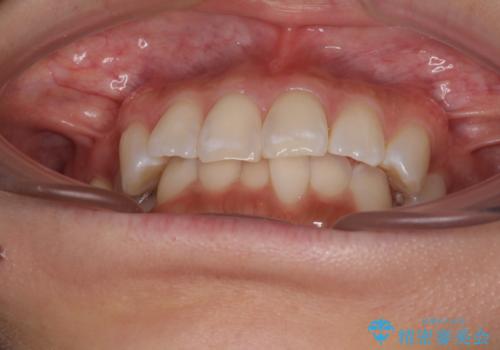 デコボコの非抜歯矯正 ワイヤー装置で楽して改善の治療前