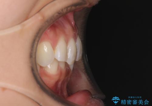 デコボコの非抜歯矯正 ワイヤー装置で楽して改善の治療前