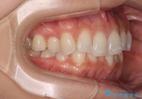 デコボコの非抜歯矯正 ワイヤー装置で楽して改善の治療前