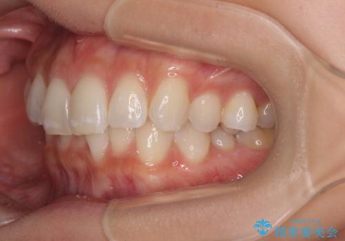 デコボコの非抜歯矯正 ワイヤー装置で楽して改善の治療前